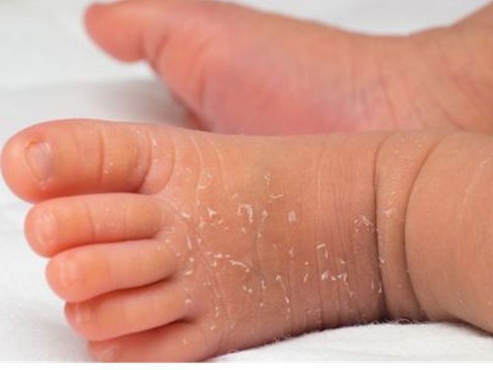 Cara Melembapkan Kulit Bayi Cara Melembapkan Kulit Bayi