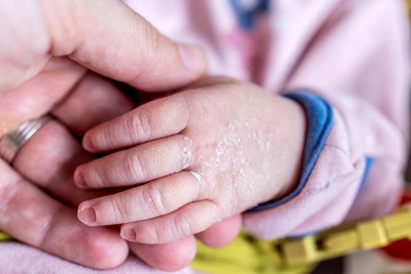 Cara Mengatasi Kulit Bayi Kering Dan Mengelupas Cara Mengatasi Kulit Bayi Kering Dan Mengelupas